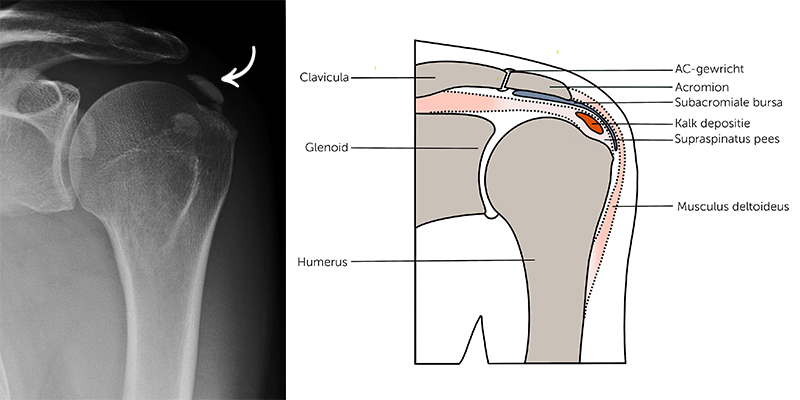 De behandeling van calcificerende tendinopathie van de schouder | & Wetenschap