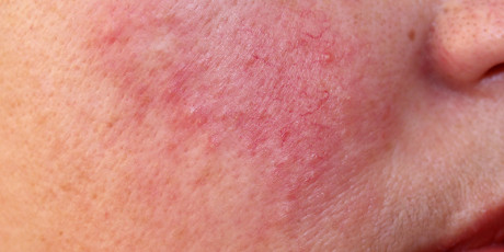 Rosacea