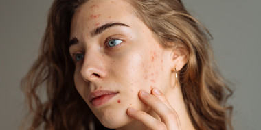 Close-up van vrouw met acne