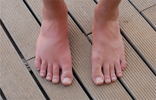 Zwelling van de voet na een steek van een pieterman.