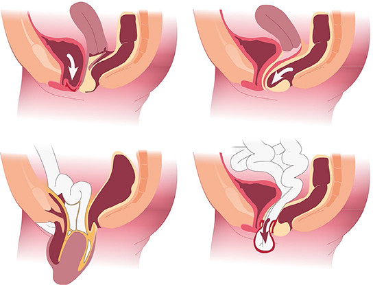 Typen prolaps van links naar rechts, van boven naar beneden: prolaps voorwand; prolaps achterwand; prolaps uterus; prolaps vaginatop na uterusextirpatie