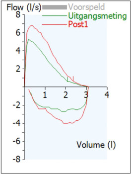 Flow-volumecurves. De uitgangsmetingen corresponderen met de pre-waarden in de tabellen