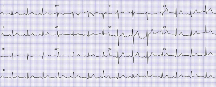 Ecg A