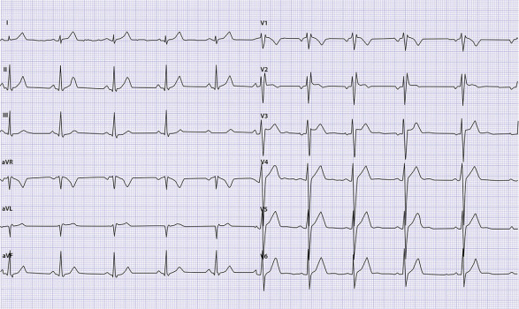 Ecg B