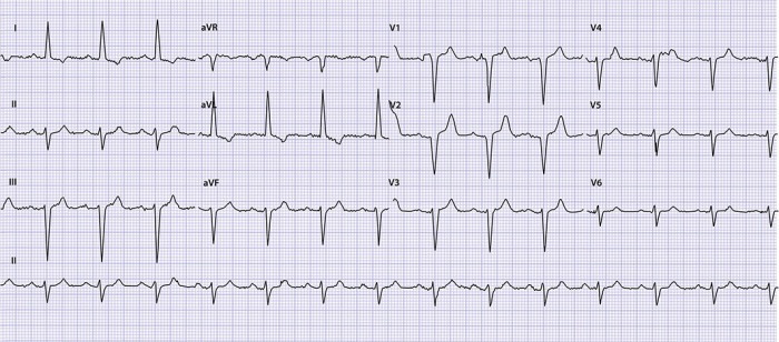 Ecg C