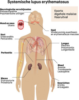 Veelvoorkomende symptomen van SLE