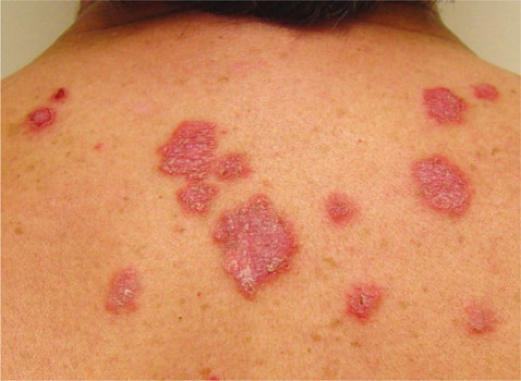 Subacute cutane lupus erythematosus