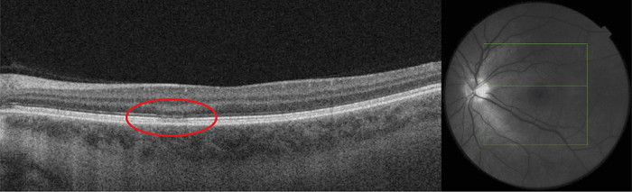 Optische coherentietomografie (OCT) van het linkeroog van Anna