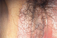 Genitale psoriasis