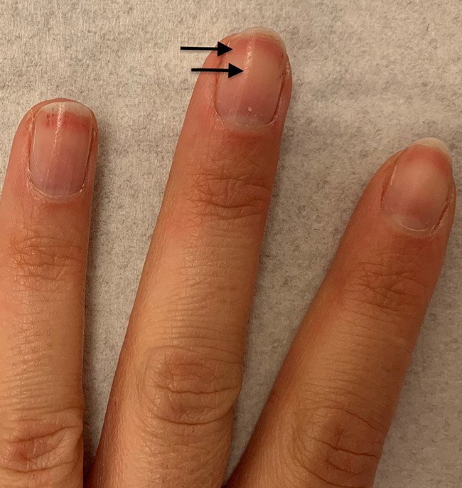 Toestemming omverwerping omringen Rode randen onder de nagels | Huisarts & Wetenschap